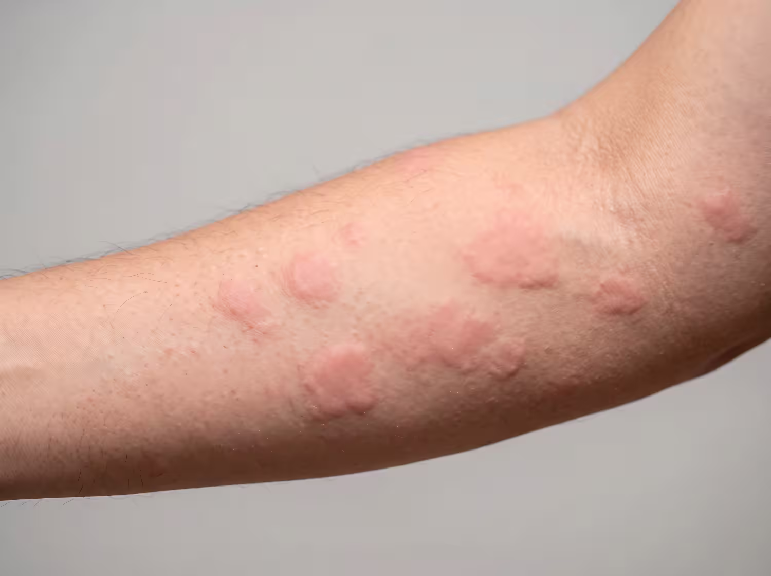 allergy hives Dubai - skin reaction symptoms and DrPlus allergy testing